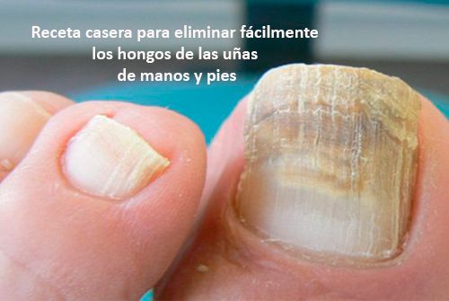 Como eliminar los hongos